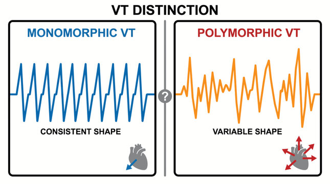 Ventricular Tachycardia Monomorphic Polymorphic Distinction Diagram
