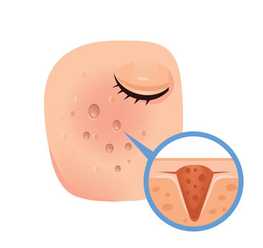 Ice Pick Acne Scar Anatomy Illustration