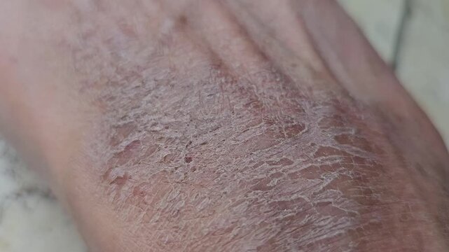 Close-up view of severely dry scaly and flaky skin on human hand or foot highlighting dermatological issues like eczema ichthyosis or severe xerosis cutis