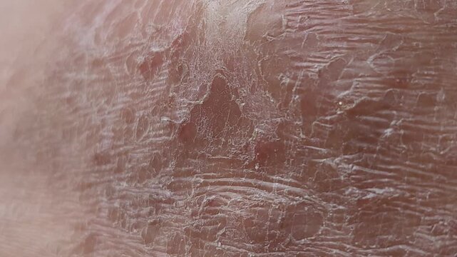 Macro video of severe skin peeling and flaking on human skin showing dead epithelial cells detaching due to sunburn dermatitis or other dermatological issues with underlying red irritation