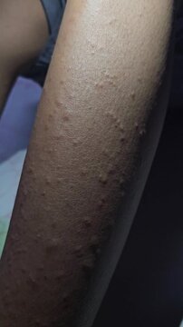 Macro shot of a person's arm with an itchy red rash and bumps indicating a chikungunya viral infection