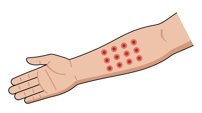 Human forearm skin prick test for allergy diagnosis allergen sensitivity dermatology clinic immune reaction medical screening patient care histamine response clinical healthcare education resource