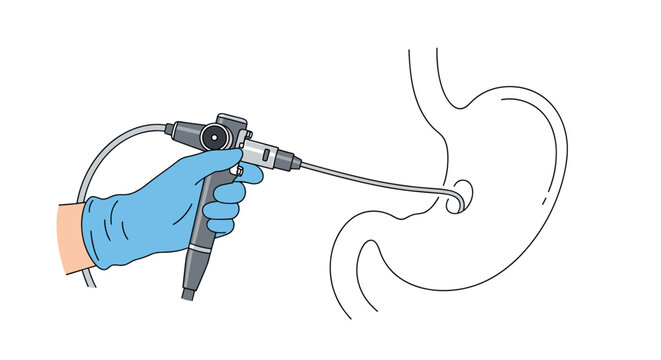 Gastroscopy medical procedure illustration showing an endoscope examining a human stomach interior for gastroenterology and cancer screening.