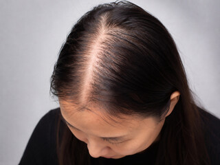 Fototapeta premium Female Pattern Hair Loss Viewed at 45 Degree Angle with Visible Scalp Thinning