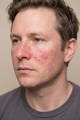 Fototapeta premium Man showing skin condition with redness on face indoors in simple lighting