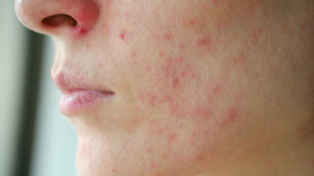Extreme close up woman facial skin with red pimples and spots, showing an allergic reaction, acne, or dermatitis. Unhealthy irritated epidermis problem needing dermatology care