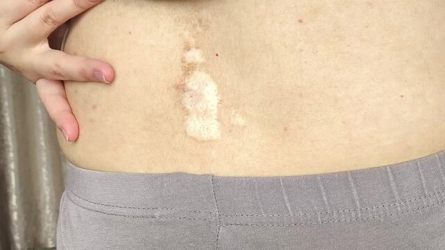 Spine scar on lower back, medical concept of vertebral injury, back surgery and healthcare.