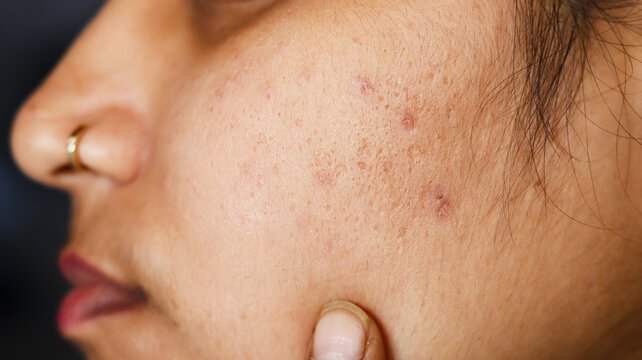 A close-up shot of an Indian woman pointing to acne scars and skin texture on her cheek. An authentic lifestyle clip focusing on skincare, dermatology, and natural skin health.
