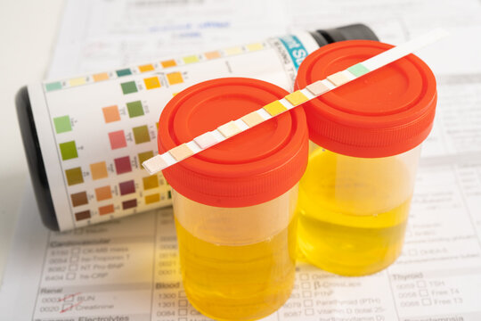 Urinalysis, urine cup with reagent strip pH paper test and comparison chart in laboratory.