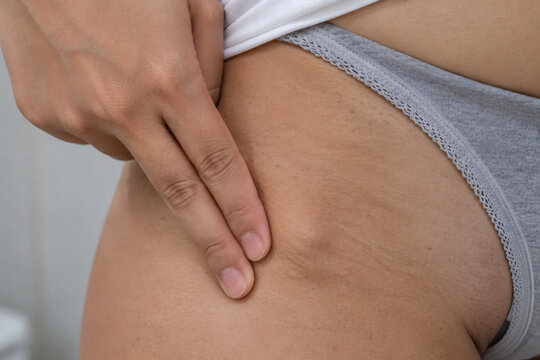 Asian Female Performing Self Examination of Enlarged Inguinal Lymph Node