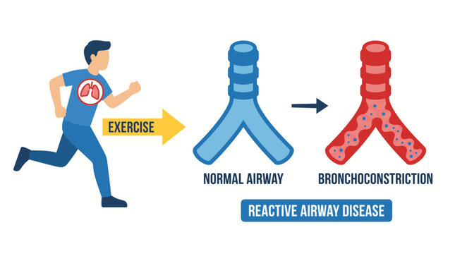 Reactive Airway Disease Bronchoconstriction Triggered by Exercise