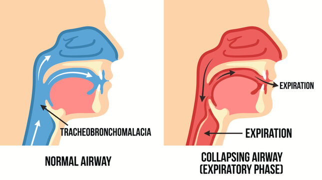 Tracheobronchomalacia Collapsing Airway in Expiratory Phase