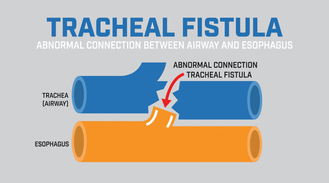 Tracheal Fistula Abnormal Connection Between Airway and Esophagus