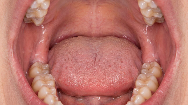 Close-up inside a healthy open mouth showing a pink tongue, upper and lower teeth, and normal oral mucosa