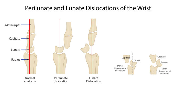 Perilunate and Lunate Dislocations of the Wrist,normal wrist alignment with perilunate and lunate dislocations, highlighting characteristic carpal bone displacement patterns.