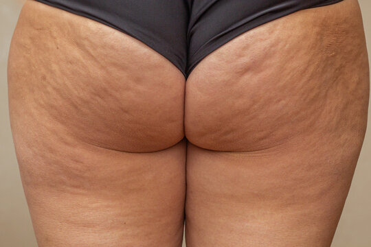Cropped close up thighs of woman with cellulite dimples
