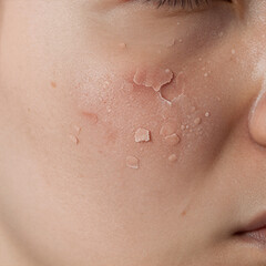 Fototapeta premium Cartoon Texture Unhealthy. Close-Up Of Unhealthy Human Skin Epidermis With Flaky And Cracked Texture