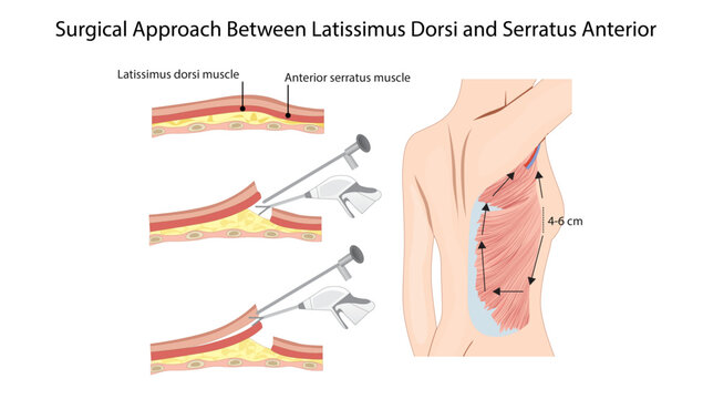 Surgical Approach Between Latissimus Dorsi and Serratus Anterior, demonstrating the surgical plane between the latissimus dorsi and serratus anterior muscles for thoracic and scapular surgical.