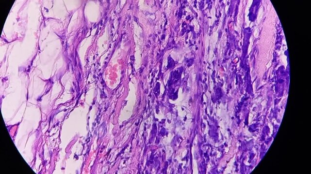 Histopathology of right breast lump. Infiltrating ductal carcinoma (nst), well differentiated G-1. Section of breast tumour reveal features of an infiltrating ductal carcinoma. 