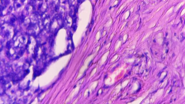 Histopathology of right breast lump. Infiltrating ductal carcinoma (nst), well differentiated G-1. Section of breast tumour reveal features of an infiltrating ductal carcinoma. 