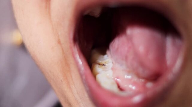 A close-up shot showing a dental cavity on a molar tooth inside an open mouth. Useful for educational content regarding oral hygiene, dental care, and cavity awareness.
