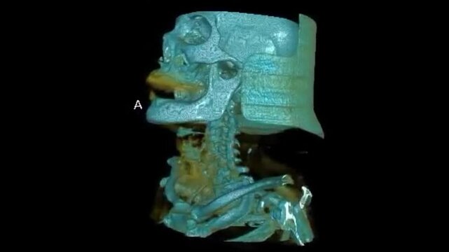 Volumetric 3D Model Render of Cervical Vertebrae and Throat Architecture for Preoperative Surgical Navigation