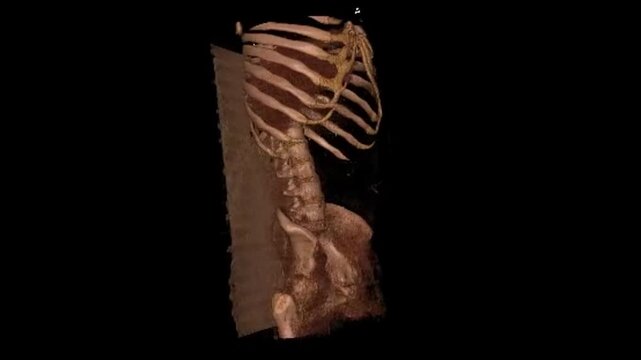 Thin Slice 3D Computed Tomography KUB Scan Loop for Kidney Stone and Ureteric Calculus Evaluation