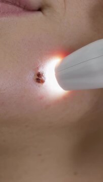 Vertical video: Shining white pen activating red tip on lower cheek near mouth, treating dark spot