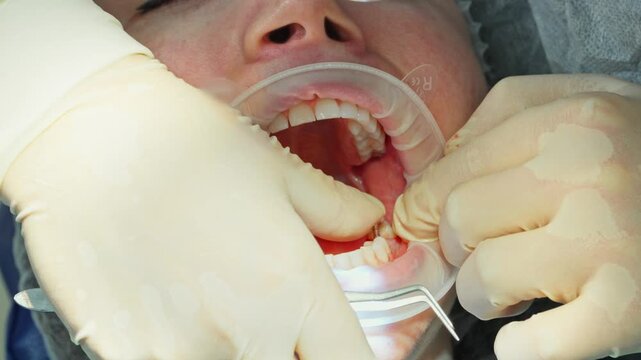  A close-up of dentists drilling a hole for a dental implant in the jaw of a young adult female patient with a dental drill, while draining excess saliva. Footage of a real-life surgical procedure