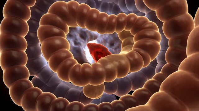Minor Duodenal Papilla With Stenotic Opening for Pancreatic Duct Education