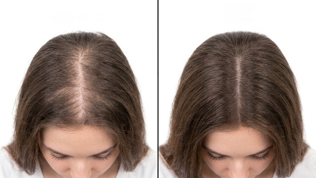 Before and after hair restoration, female pattern hair loss improvement, hair growth transformation, scalp treatment results, visible hair thickening progress, hair regrowth success, beauty care