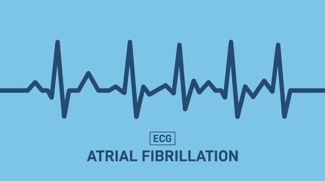 Atrial Fibrillation Irregular Heartbeat ECG Waveform Vector