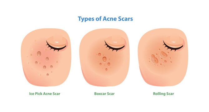 Types of Acne Scars Illustration Ice Pick, Boxcar and Rolling Scars
