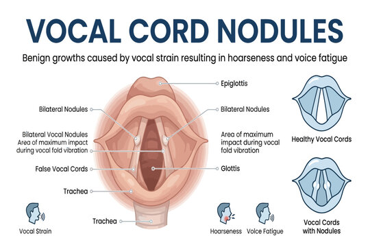 Educational diagram showing vocal cord nodules, vocal strain, and voice fatigue anatomy illustration.