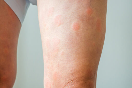 Young asian man has allergic skin rash on his legs from itchy dry skin eczema dermatitis insect bites