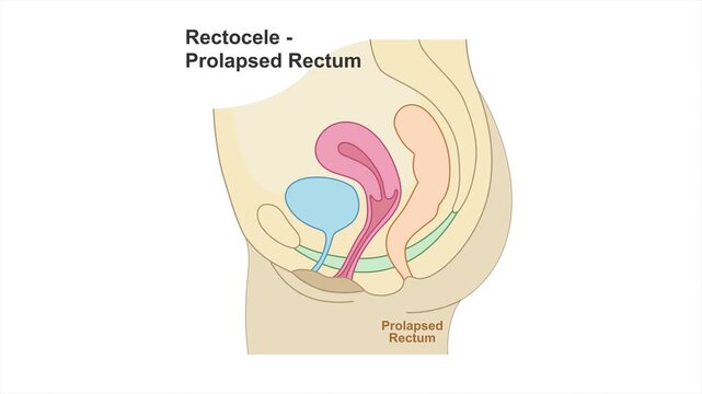 Rectocele or prolapsed rectum medical illustration showing posterior vaginal wall bulge caused by pelvic floor weakness. Female pelvic organ prolapse educational concept, 4K, white background.