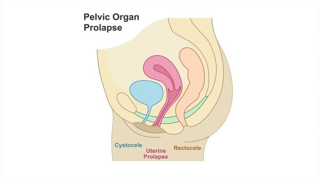 Pelvic organ prolapse educational illustration showing combined cystocele, rectocele and uterine prolapse due to weakened pelvic floor muscles. Medical OB-GYN concept, 4K, white background.