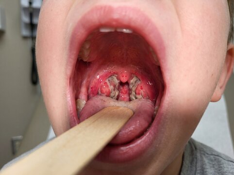Close up of diphtheria pseudomembrane on child swollen tonsil