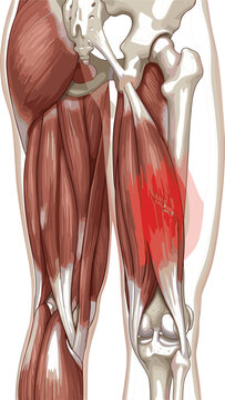 Detailed human hamstring muscle strain vector illustration showing back thigh injury posterior hip joint pelvis bone and knee anatomy