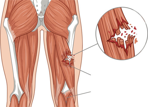 Hamstring muscle tear medical vector illustration showing severe leg strain rupture fibers and anatomical zoom details