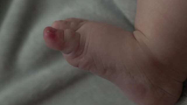 Close up of baby foot with red inflamed toe and nail infection. Macro view of infant swollen toe skin, pediatric paronychia or ingrown toenail issue. Healthcare and medical concept.