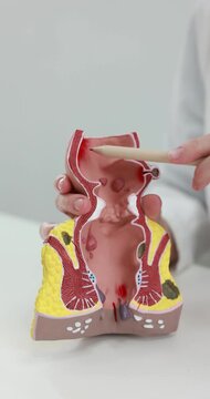 Doctor showing model of unhealthy lower rectum at white table in clinic, closeup