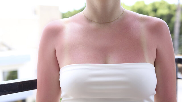 Close-up of woman&rsquo;s red sunburned shoulder and collarbone with visible tan lines, summer skin irritation and UV damage concept.