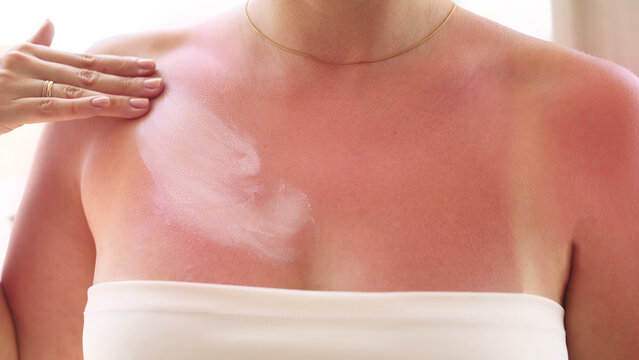 Woman with painful sunburned skin on chest and shoulders after summer vacation, close-up of red irritated skin with tan lines, after sun care and UV protection concept.