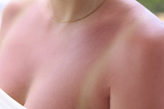 Close-up of red sunburned female chest and shoulder with visible tan lines after excessive sun exposure, summer vacation skincare, sun damage and skin irritation concept.