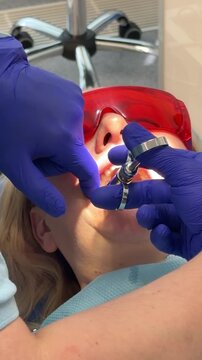 Complete dental filling procedure with patient dentist microscope anesthesia rubber dam and modern restorative treatment set. professional dental care.