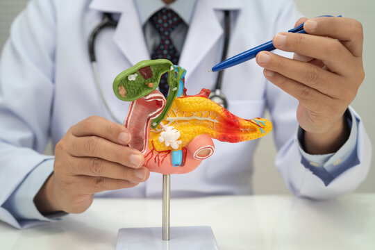 Pancreatitis, pancreatic cancer, Asian doctor with pancreas, gallbladder and bile duct human anatomy model at hospital.