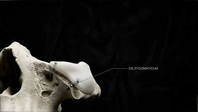 Revealing precision of a facial bone implant on the intricate human Zygomatic structure