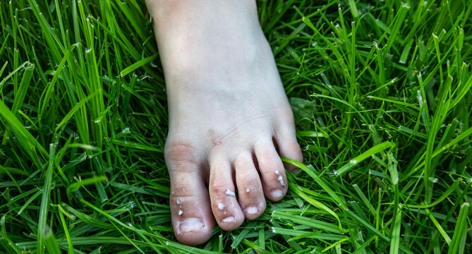 Treating a child's scratched toes with antiseptic on green grass