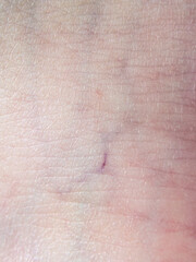 Fototapeta premium Close up view of early stage varicose veins on caucasian human skin